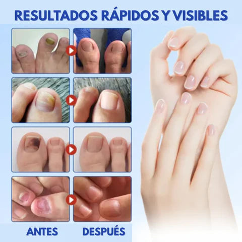 NailShield - Elimina hongos y devuelve tus uñas a la normalidad