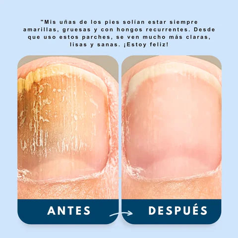 NailShield - Elimina hongos y devuelve tus uñas a la normalidad